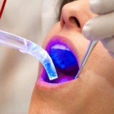 Laser Dentistry San Diego