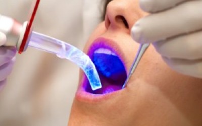 Laser Dentistry San Diego