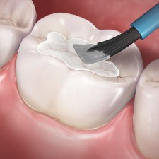 Dentist Filling San Diego
