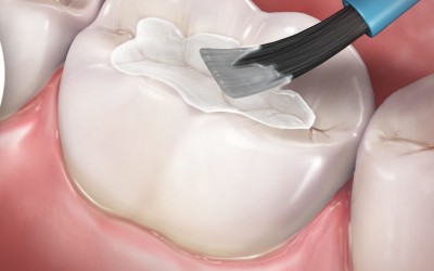 Dentist Filling San Diego